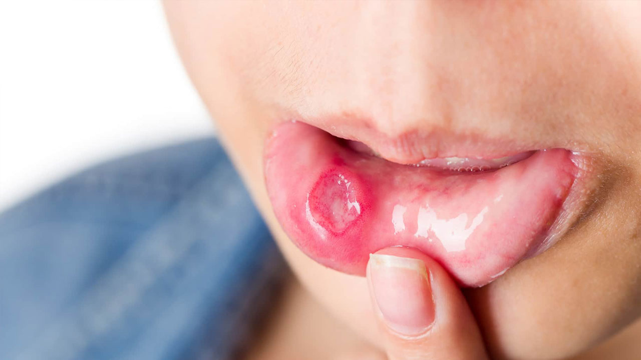 Causes Of Mouth Sores And Its Treatments
