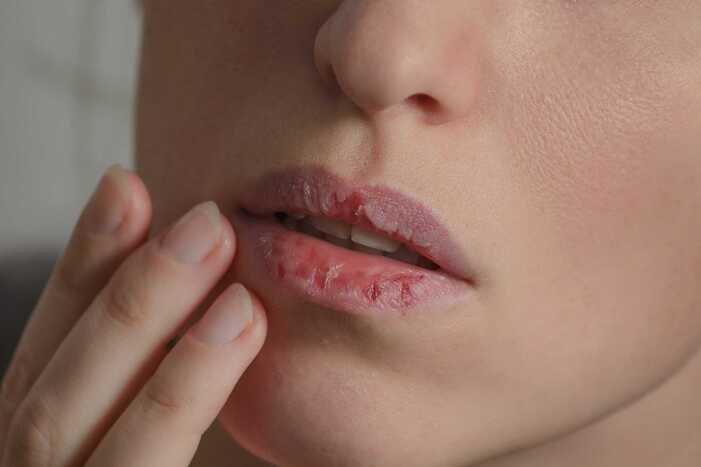 Early Signs of Dry Mouth