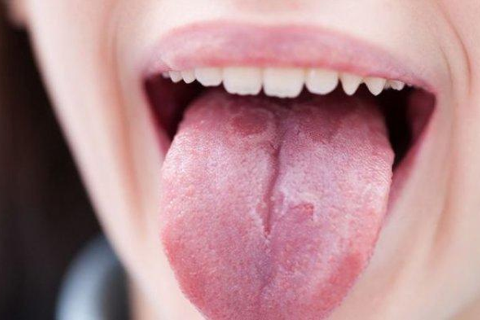 Is Your Mouth on Fire? Exploring the Mysteries of Burning Mouth Syndrome