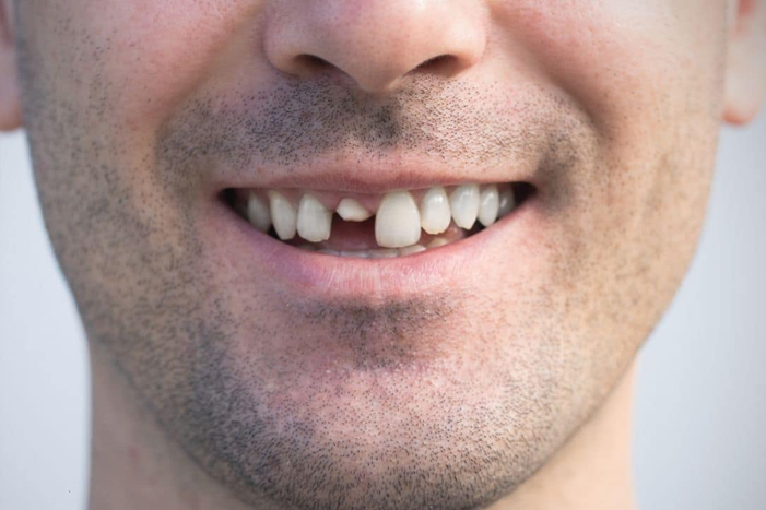 How to Fix a Cracked Tooth: Everything You Need to Know