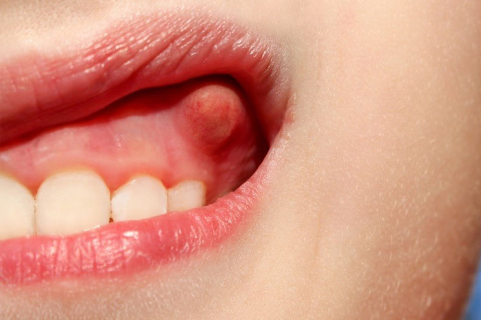 Understanding Oral Fibromas: Causes, Symptoms, and Treatment Options